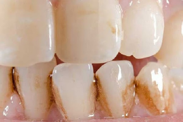Những trường hợp về răng có thể ứng dụng CAD/CAM