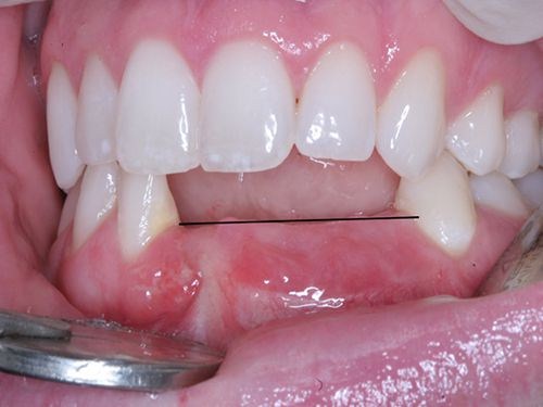 Những trường hợp mất răng lâu ngày nên trồng răng Implant