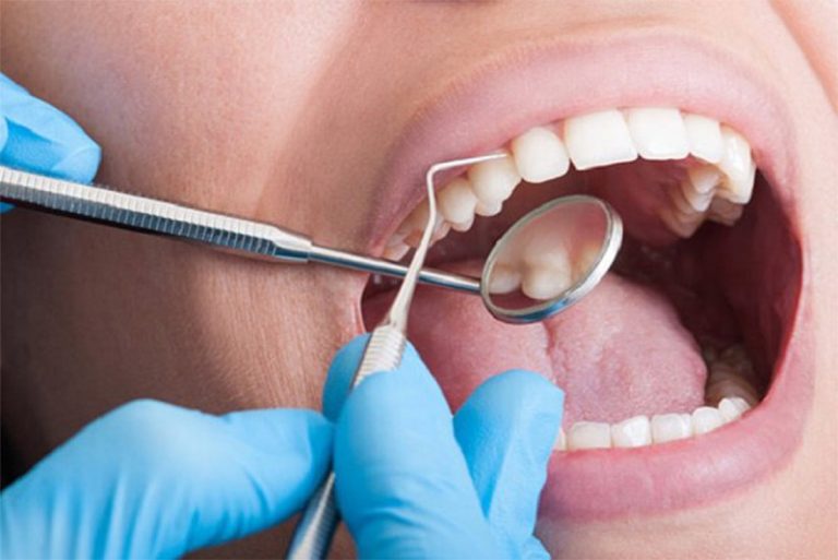 Những trường hợp có thể sử dụng phương pháp trám răng