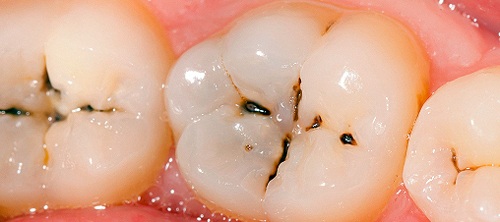 Răng implant không mắc các bệnh lý về răng