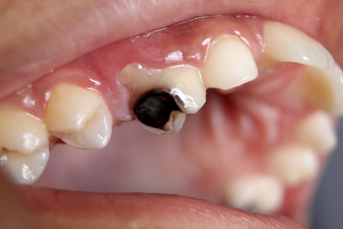 Hãy điều trị sâu răng trước khi tiến hành niềng răng