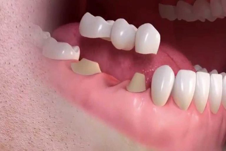 Phương pháp lắp cầu răng là gì?