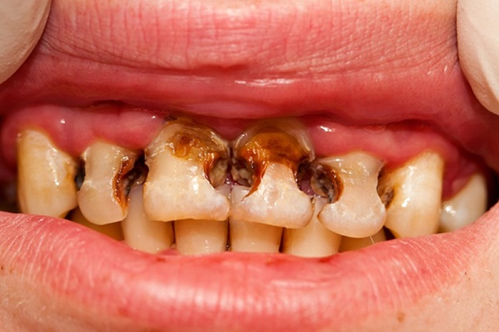 Sâu răng dẫn đến hỏng tủy ở trẻ 