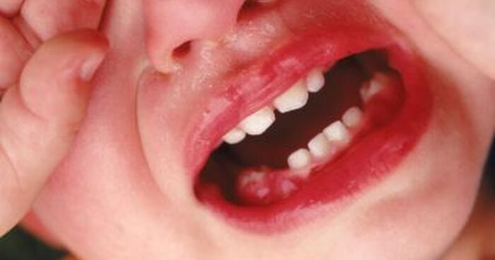 Sâu răng sưng lợi ở trẻ
