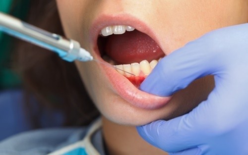 Trám răng chích thuốc tê trong những trường hợp cần thiết