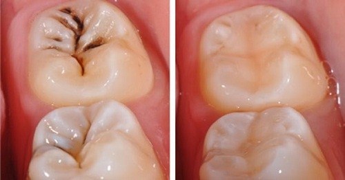 Trám răng chích thuốc tê khi thực hiện điều trị bệnh lý