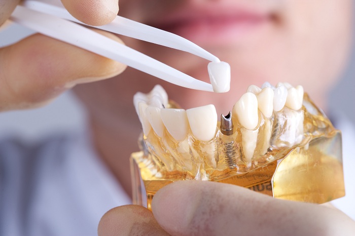 Trồng răng Implant là phương pháp phục hình răng bị mất cho hiệu quả vượt bậc.