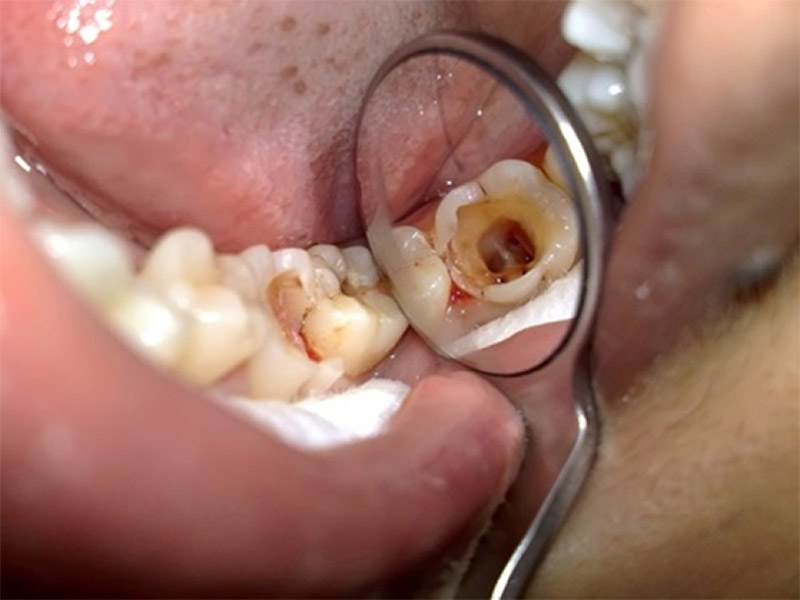 Vị trí mọc của răng khôn rất khó vệ sinh dễ gây sâu răng