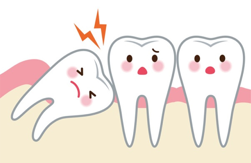 Răng khôn trong quá trình mọc sẽ có khả năng gây ảnh hưởng tới các răng bên cạnh