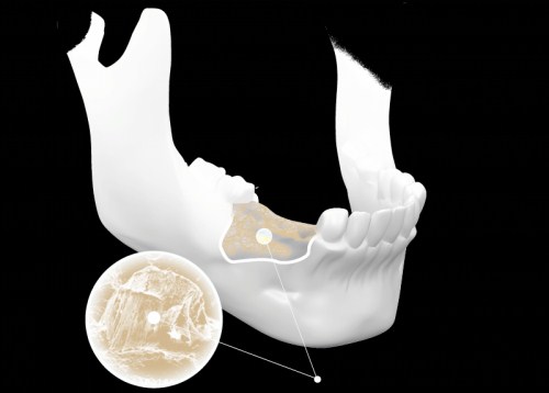 Xương hàm phải đảm bảo đúng tiêu chuẩn mới có thể trồng răng Implant