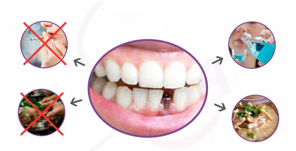 Cấy ghép implant có gây dị ứng?