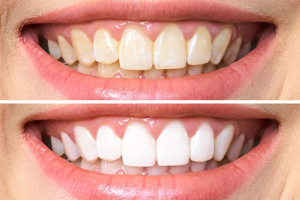 3 cách làm trắng răng bằng oxy già tại nhà