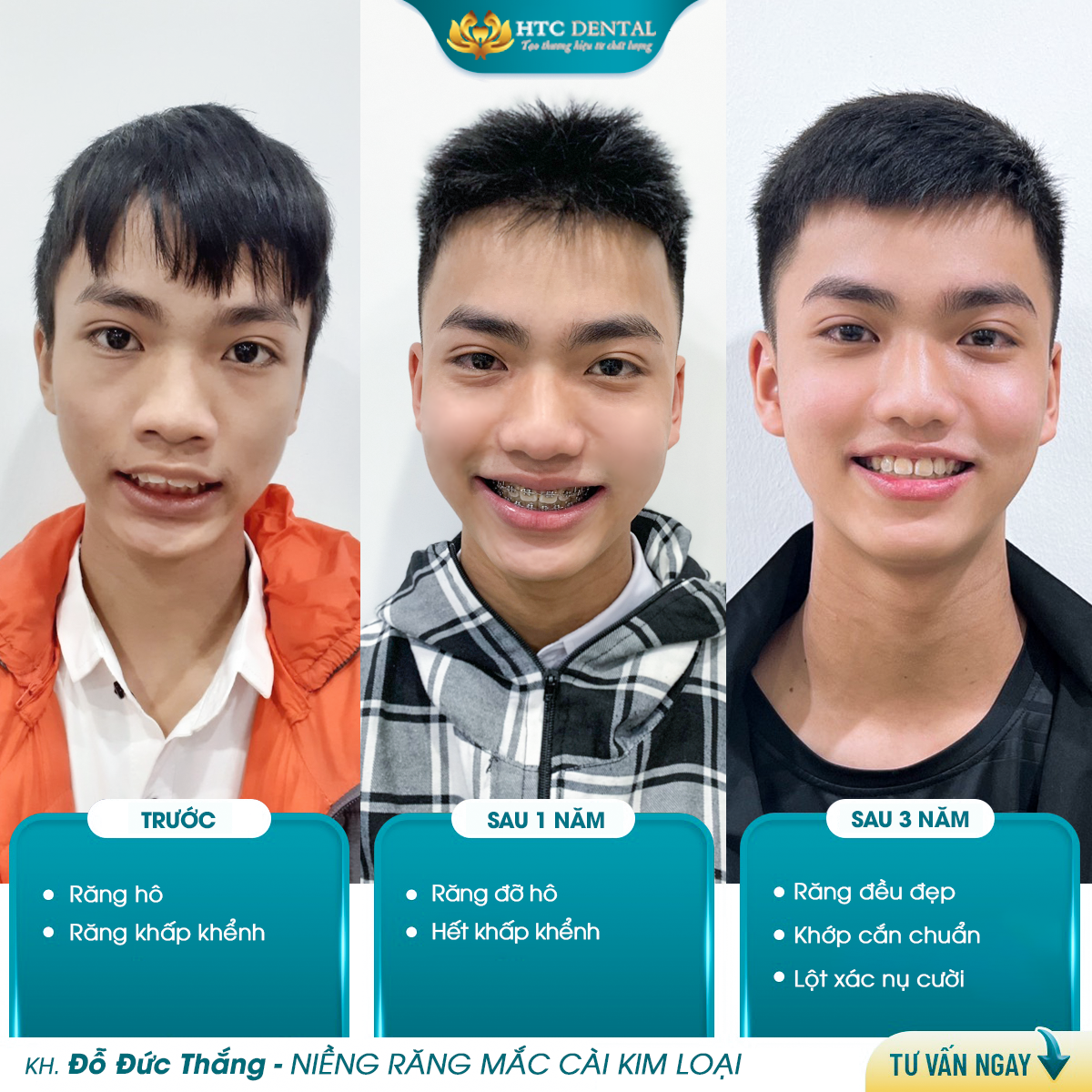 3 Cạm Bẫy Niềng Răng Nguy Hiểm Bạn Cần Biết Trước Khi Quyết Định