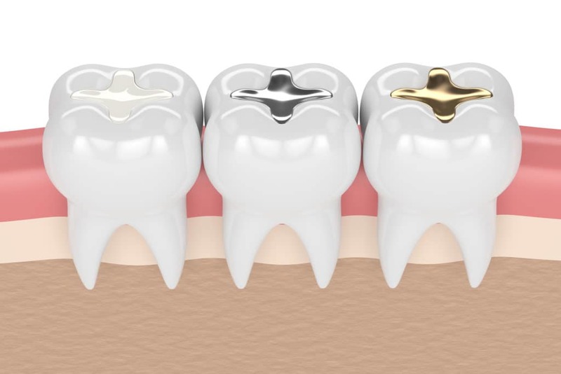 5 loại vật liệu trám răng được nhiều người dùng nhất