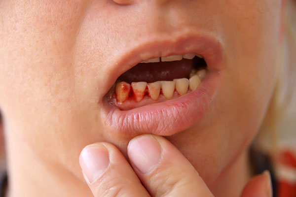 7 Mẹo điều trị chảy máu chân răng tại nhà ít tốn kém mà hiệu quả