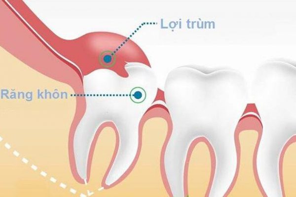 Bạn đã hiểu đúng về viêm lợi trùm răng khôn?