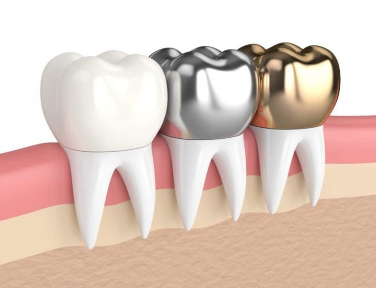 Mão răng kim loại được chế tác từ vật liệu hợp kim bao gồm nhiều kim loại