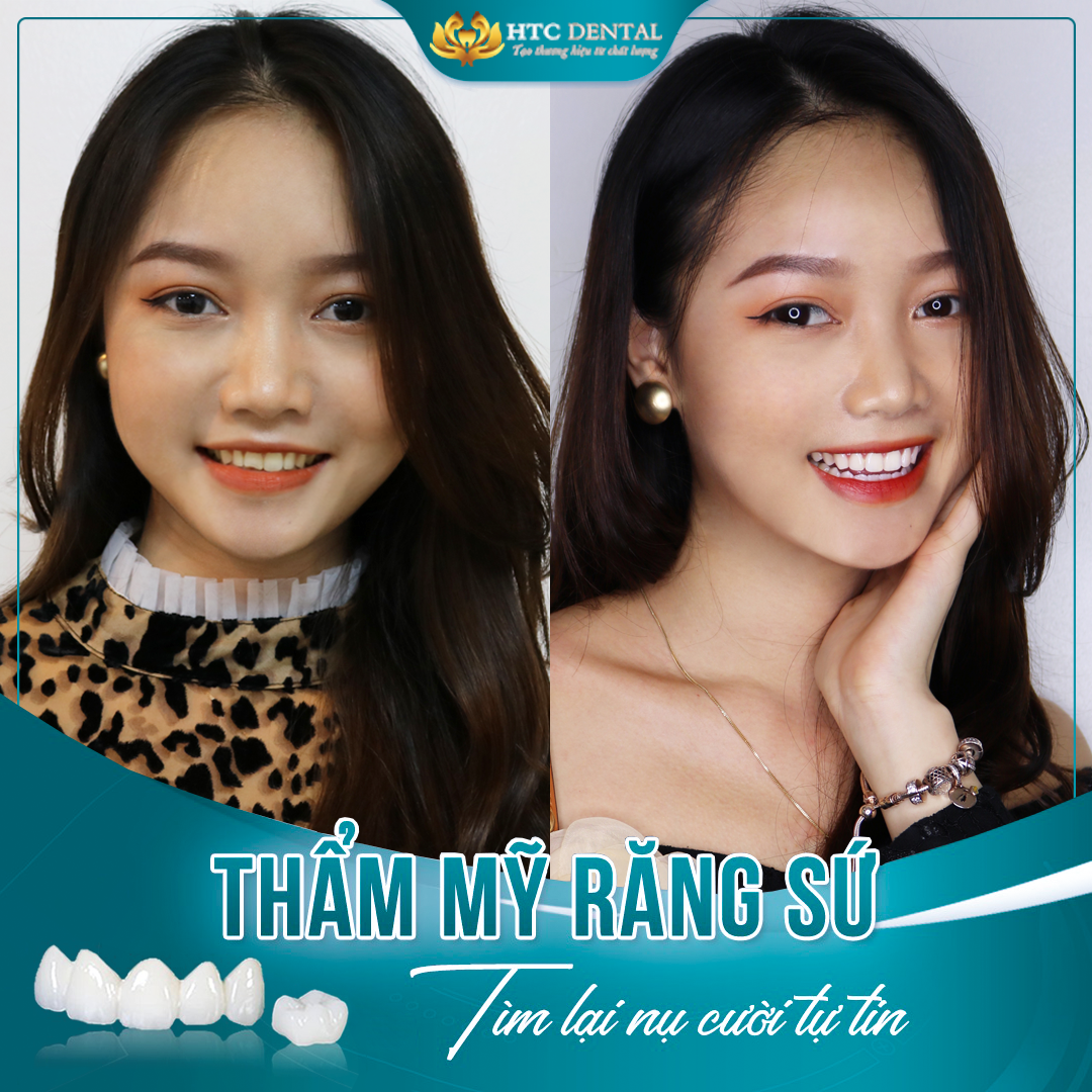 Bọc răng sứ có đau không? Có ảnh hưởng đến răng thật không?