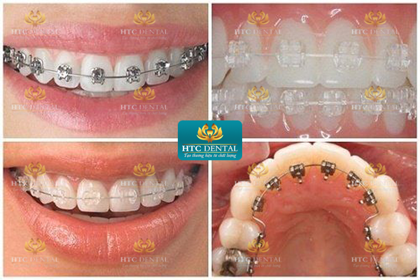 Các loại niềng răng hiện nay: So sánh chi tiết – Nên chọn loại nào để ít đau, hiệu quả cao?