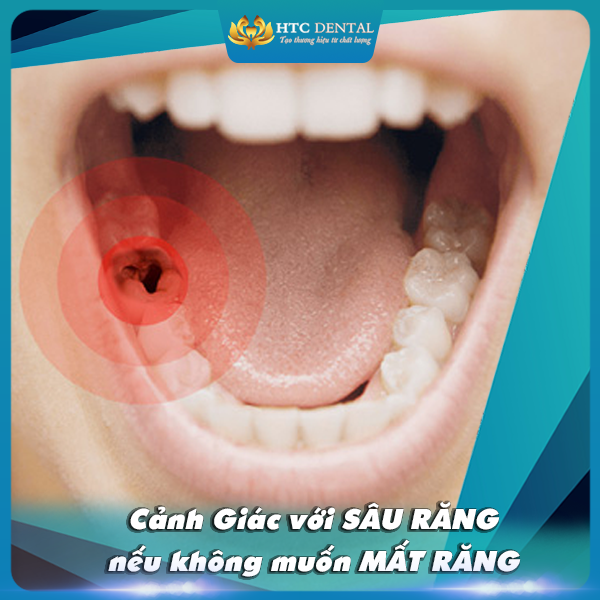 Cảnh giác với sâu răng nếu không muốn mất răng