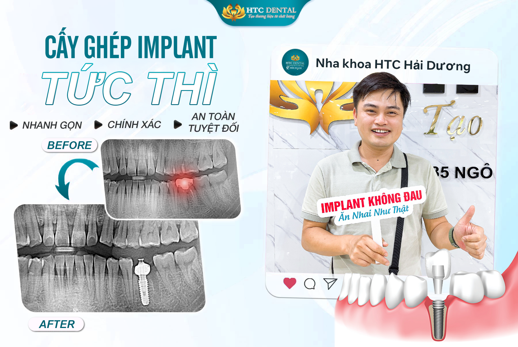 CẤY IMPLANT TỨC THÌ - LỢI ÍCH SIÊU BẤT NGỜ