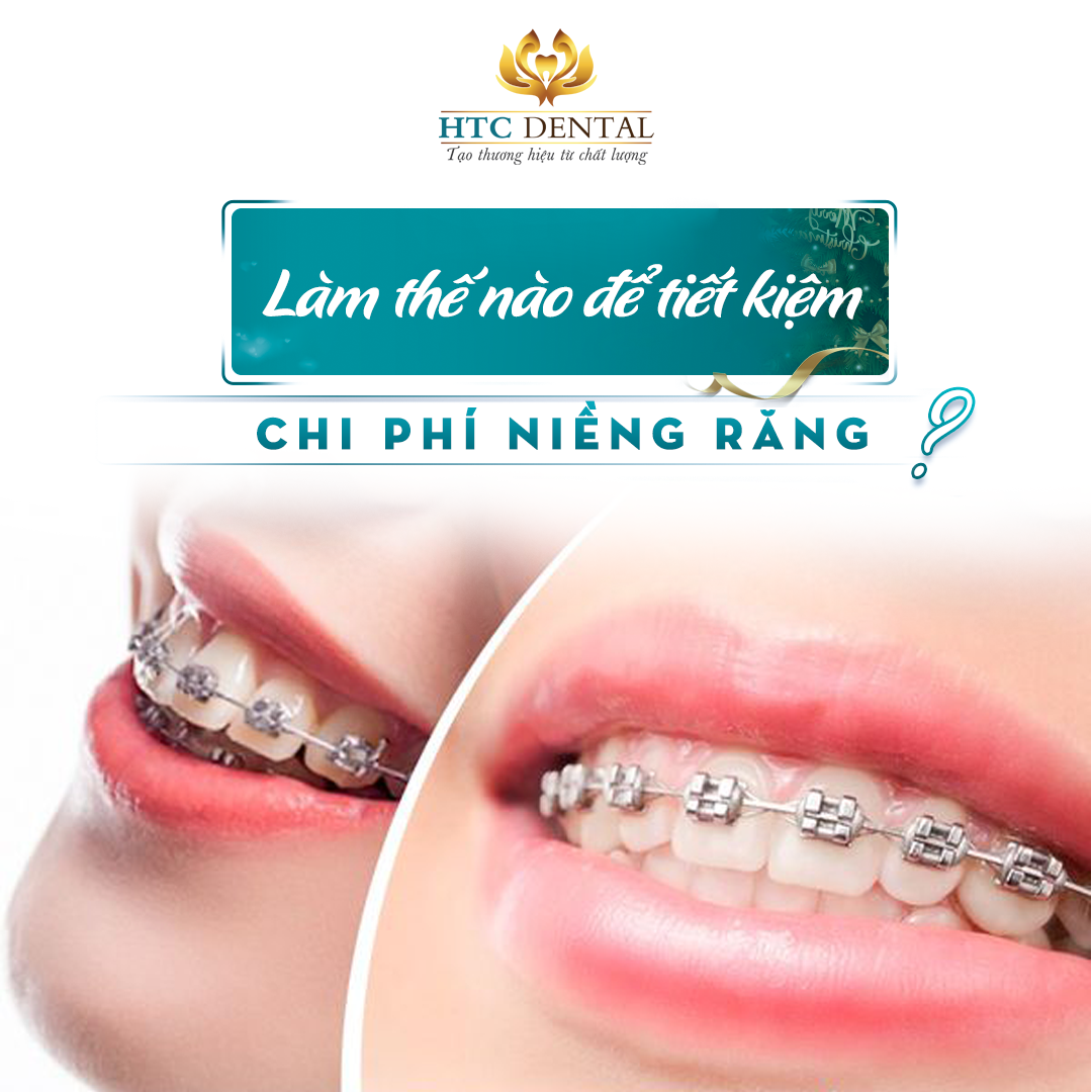 Chi phí niềng răng bao nhiêu tiền? Các yếu tố ảnh hưởng và cách tối ưu chi phí