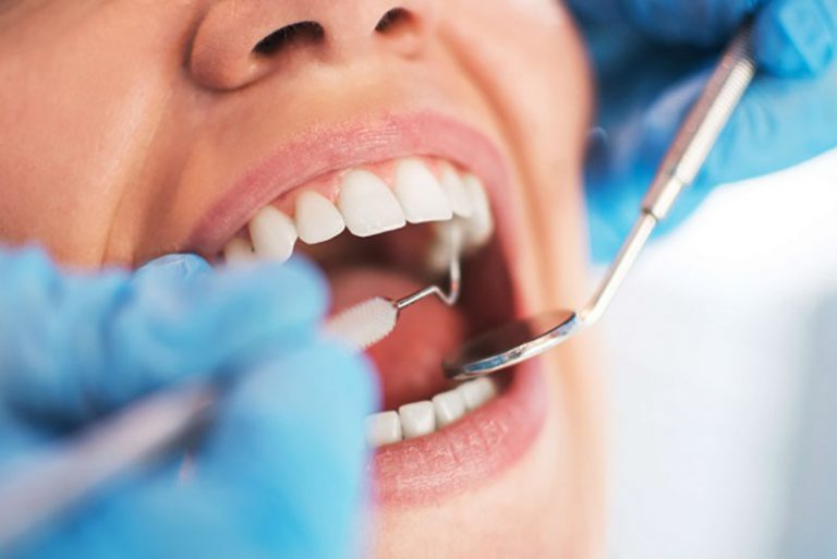 Trước khi lắp mắc cài, nha sĩ sẽ tiến hành làm sạch bề mặt răng để chuẩn bị gắn mắc cài