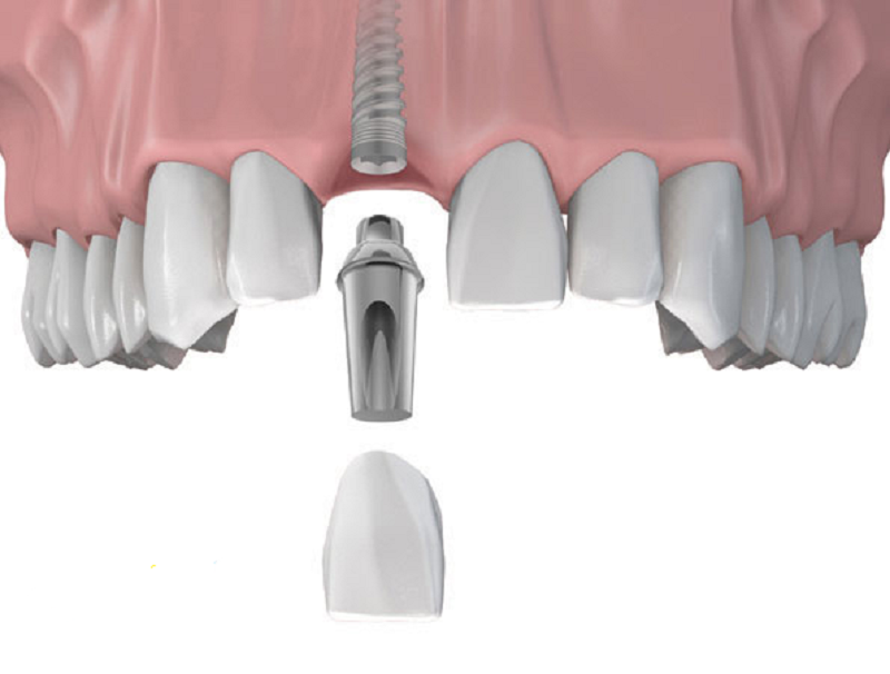 Có nên cấy ghép implant cho răng cửa?