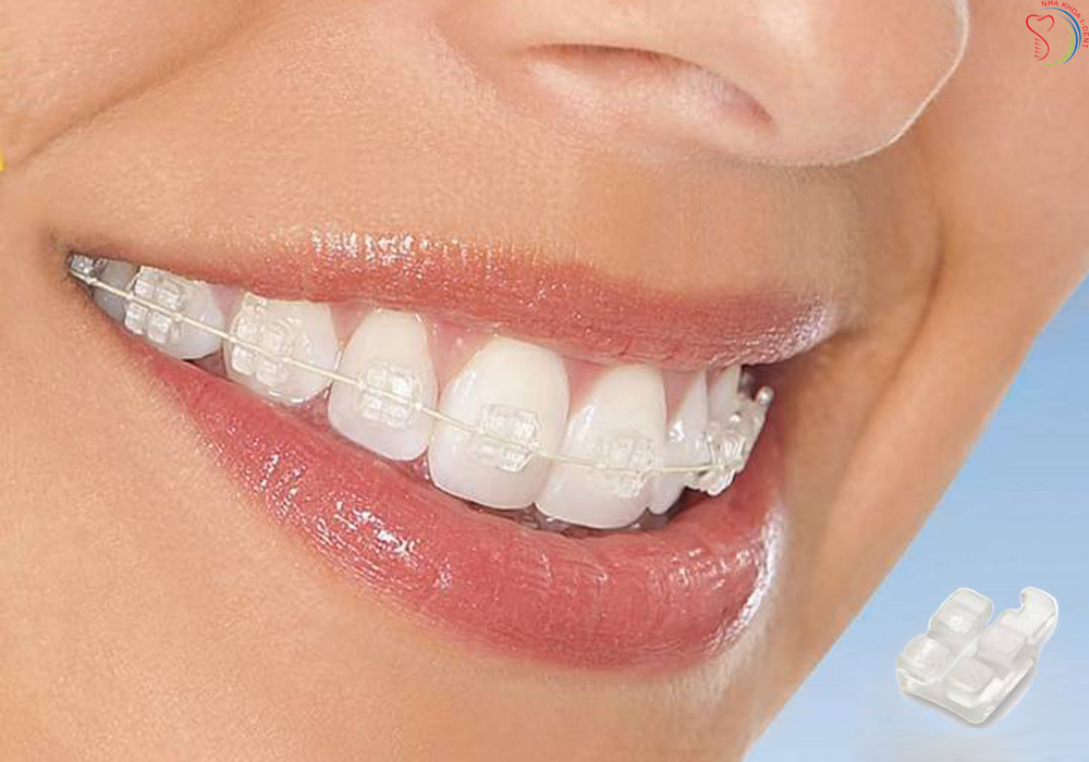 Có nên trồng răng cửa bằng răng sứ kim loại không?