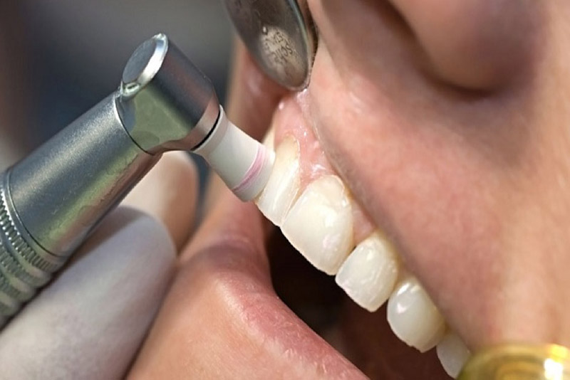 Đánh bóng răng là gì? 5 điều có thể bạn chưa biết về thủ thuật đánh bóng răng