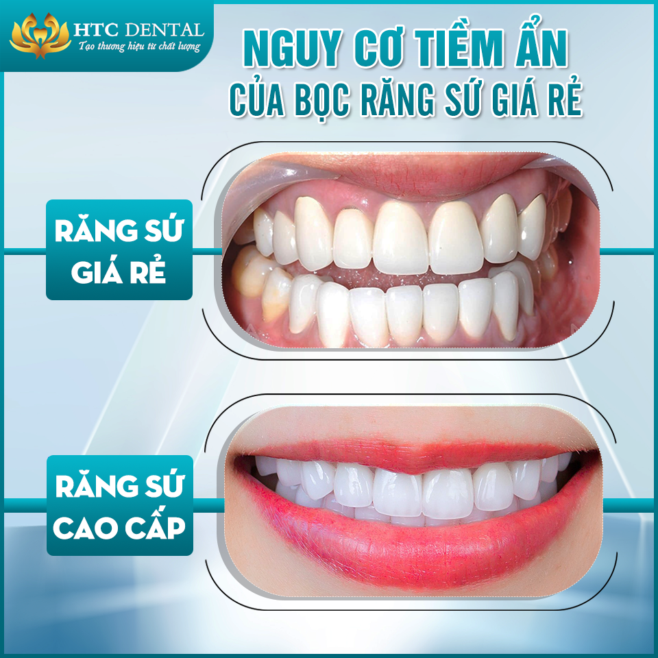 HIDDEN RISKS OF CHEAP DENTAL CROWNS – WHY YOU SHOULD CHOOSE PREMIUM PORCELAIN CROWNS