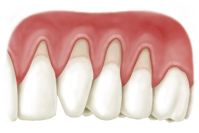 Hở chân răng là gì? Chữa hở chân răng bằng cách nào?