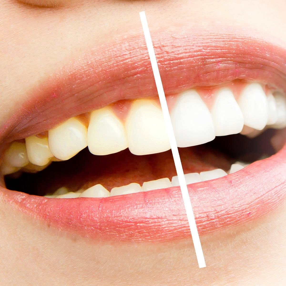 HOW TO KEEP YOUR TEETH WHITE AND BRIGHT AFTER TEETH WHITENING