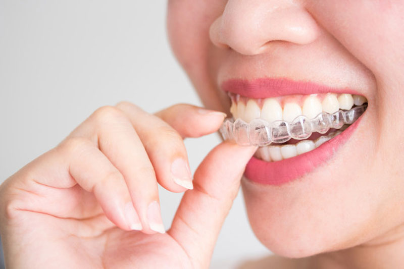 Invisalign – phương pháp niềng răng không mắc cài thẩm mỹ cao