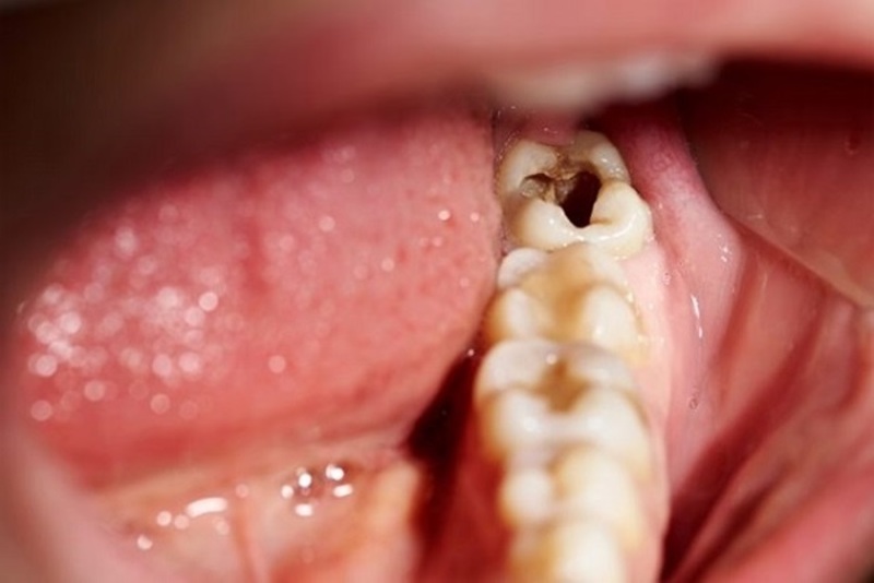 Nguyên nhân và hậu quả khi sâu răng số 8? Sâu răng số 8 nên làm gì?
