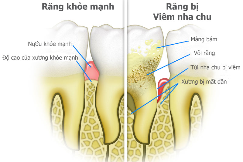 Nha chu là gì? Các cách chữa viêm nha chu răng tốt nhất cho bạn đọc