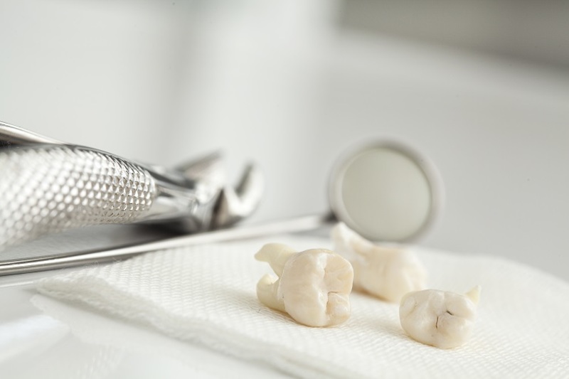 Có nên hay không nên loại bỏ răng khôn?