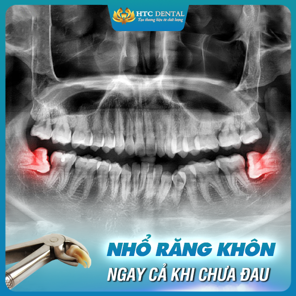 NHỔ RĂNG KHÔN NGAY CẢ KHI CHƯA ĐAU - NGHE VÔ LÝ NHƯNG LẠI CÓ LÝ DO CẢ ĐẤY