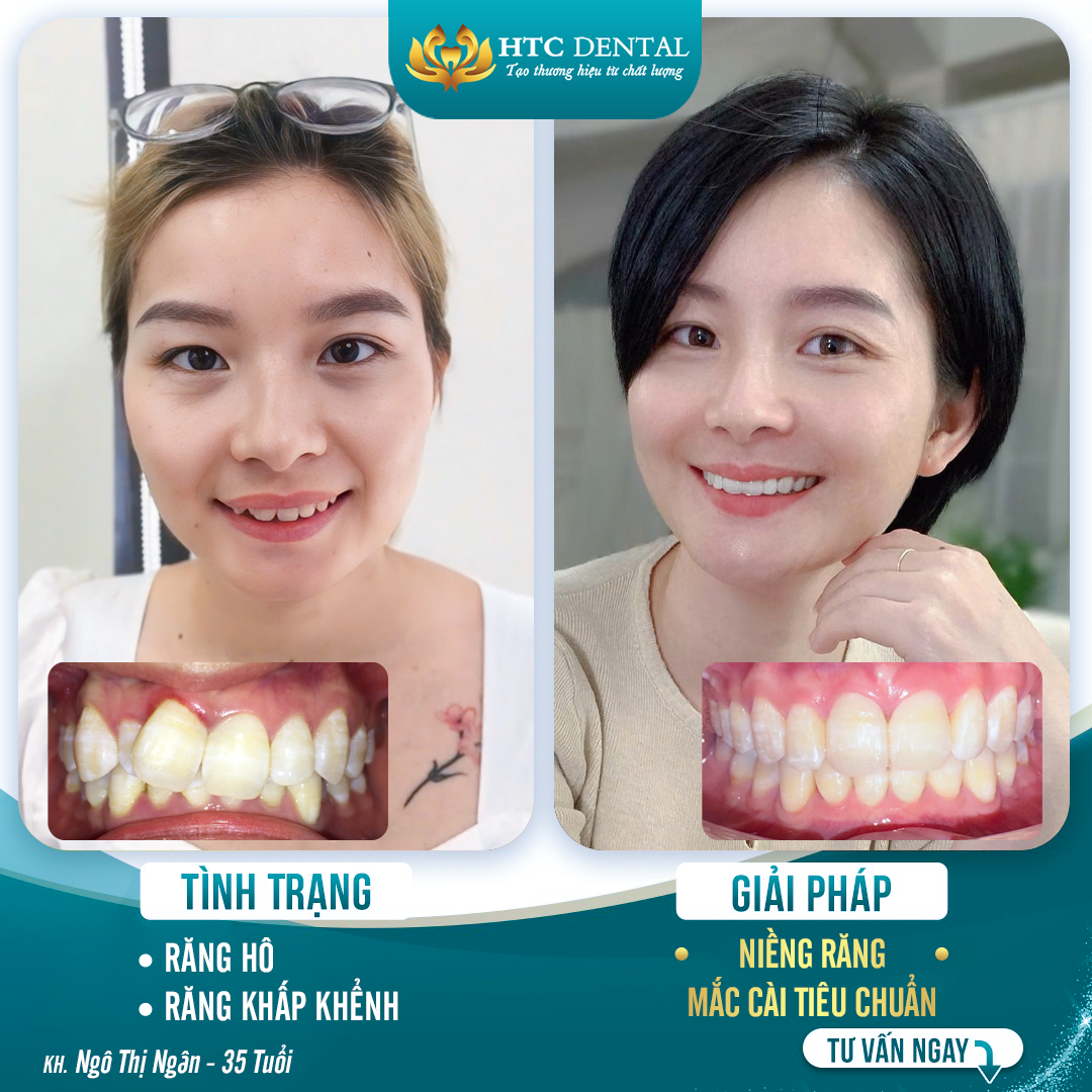 Niềng răng cho người lớn có hiệu quả không? Sự thật bạn cần biết trước khi quyết định