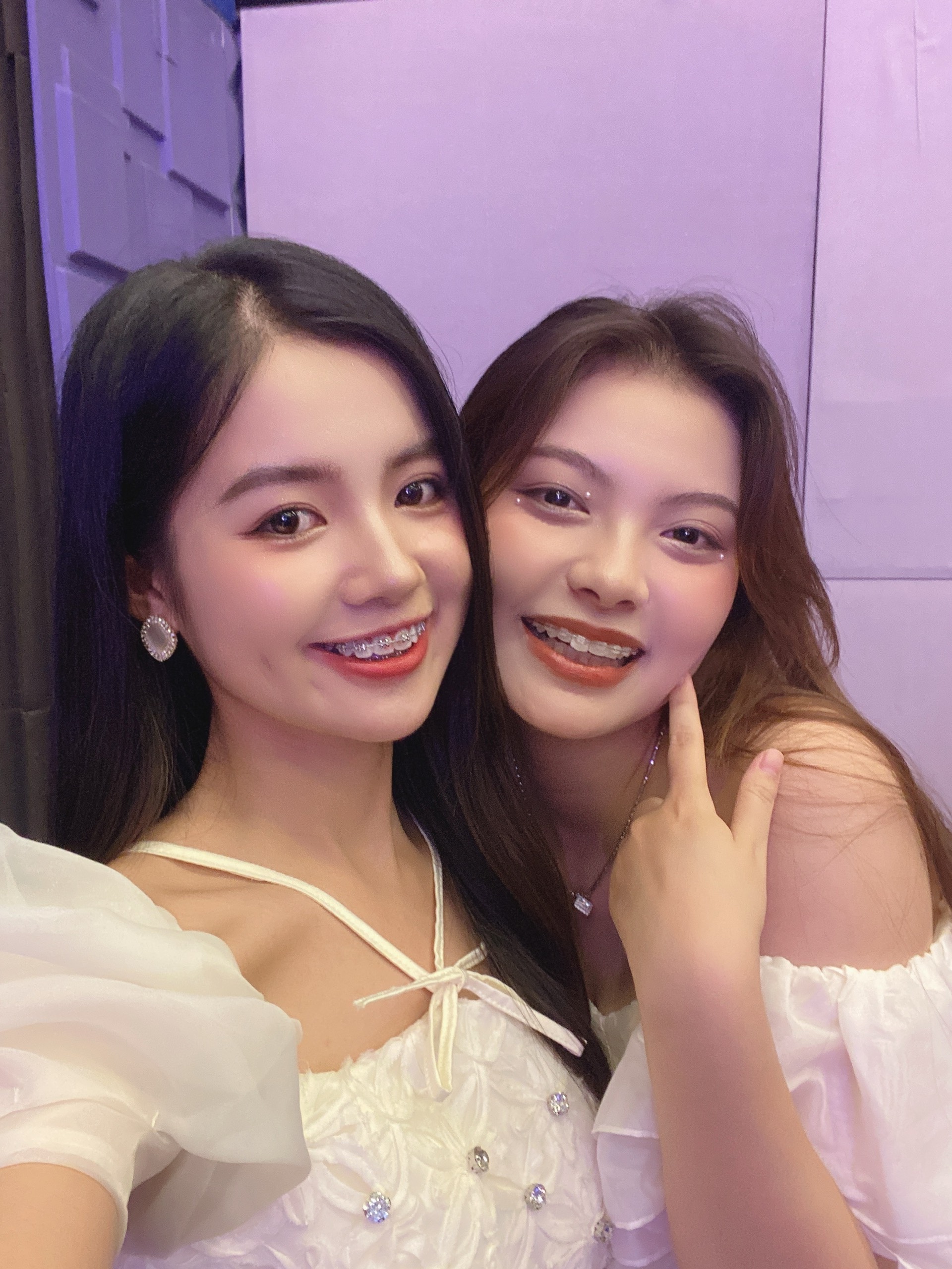 Niềng răng có đau không? Giải đáp chi tiết từ A–Z cho người lần đầu niềng răng