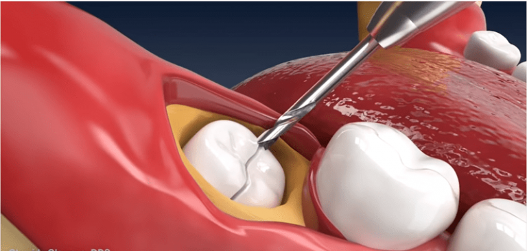 Đối với một số dạng mọc, răng khôn sẽ cần được cắt bỏ thành những mảnh nhỏ trước khi được gắp ra ngoài