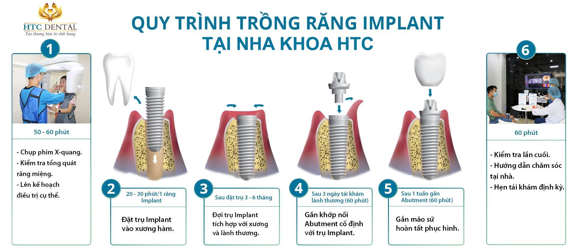 QUY TRÌNH TRỒNG RĂNG IMPLANT TẠI NHA KHOA HTC HẢI DƯƠNG – CHUẨN Y KHOA, AN TOÀN TUYỆT ĐỐI