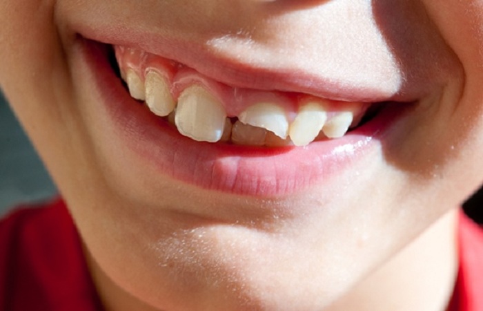 Răng đã gãy còn chân nên xử lý thế nào?