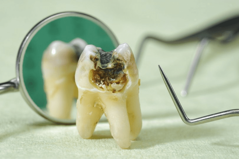 Cách chăm sóc sau nhổ răng khôn