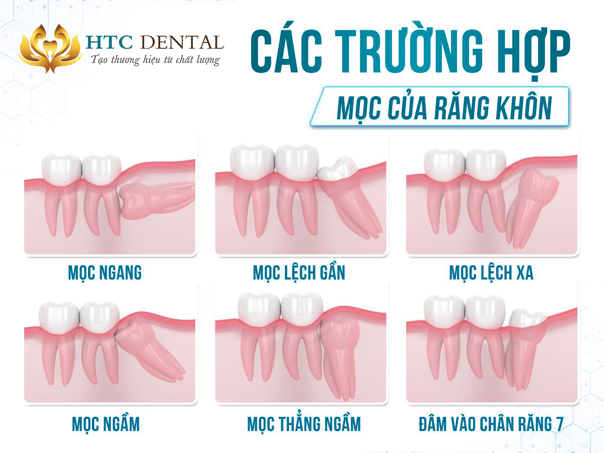 Răng khôn mọc lệch, mọc ngầm: Dấu hiệu nhận biết, biến chứng và cách xử lý an toàn