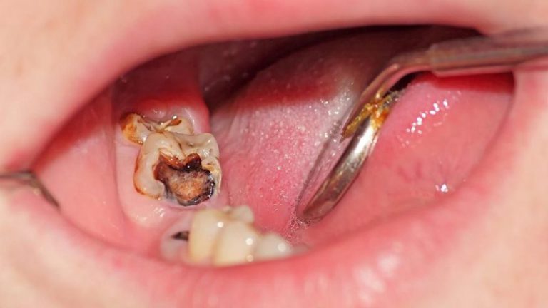 Sâu răng hàm là gì? Sâu răng hàm là hiện tượng sâu xuất hiện trên những chiếc răng mọc ở trong cùng. Được sử dụng chủ yếu để nhai và nghiền nhỏ thức ăn. Sâu răng là hiện tượng những tổn thương vĩnh viễn xuất hiện trên bề mặt cứng của răng. Từ đó dần dần phát triển thành những lỗ nhỏ.
