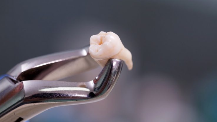 Răng khôn – Có nhất thiết phải nhổ bỏ?
