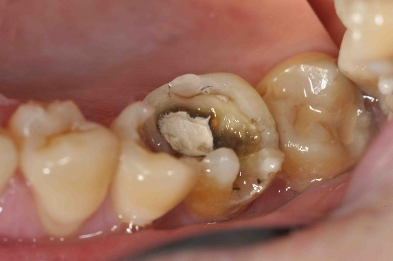 Sâu răng hàm là gì? Muốn chẩn đoán sâu răng hàm cần làm gì?