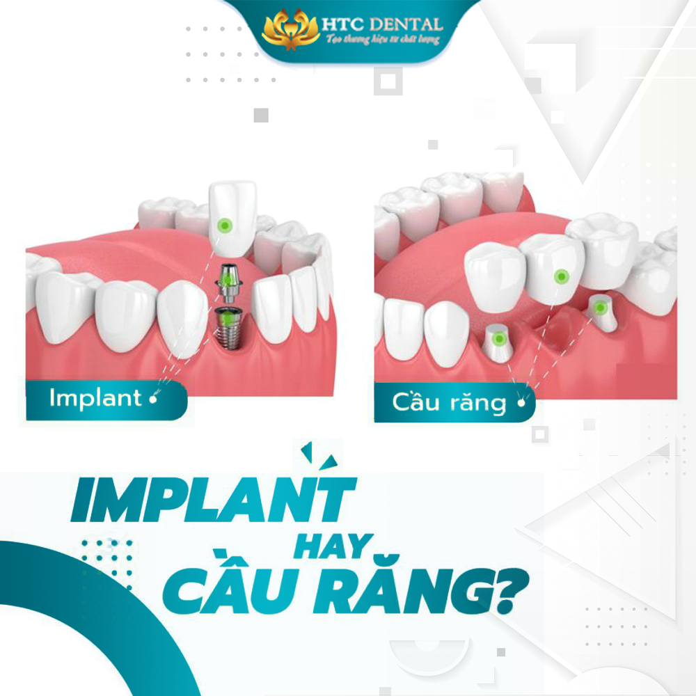 So sánh trồng răng Implant và cầu răng sứ – Nên chọn phương pháp nào tốt nhất tại Hải Dương?