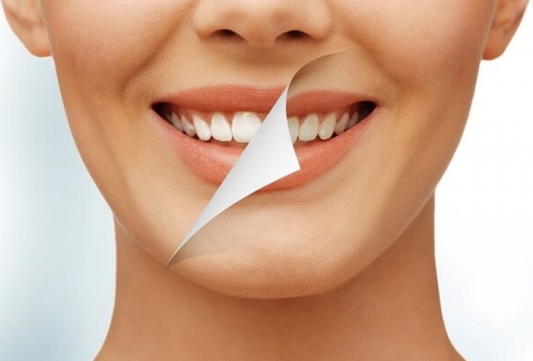 Tẩy trắng răng có gây mòn răng như tưởng tượng?